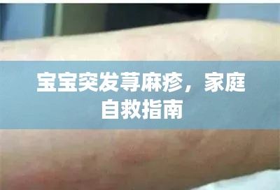 宝宝突发荨麻疹，家庭自救指南